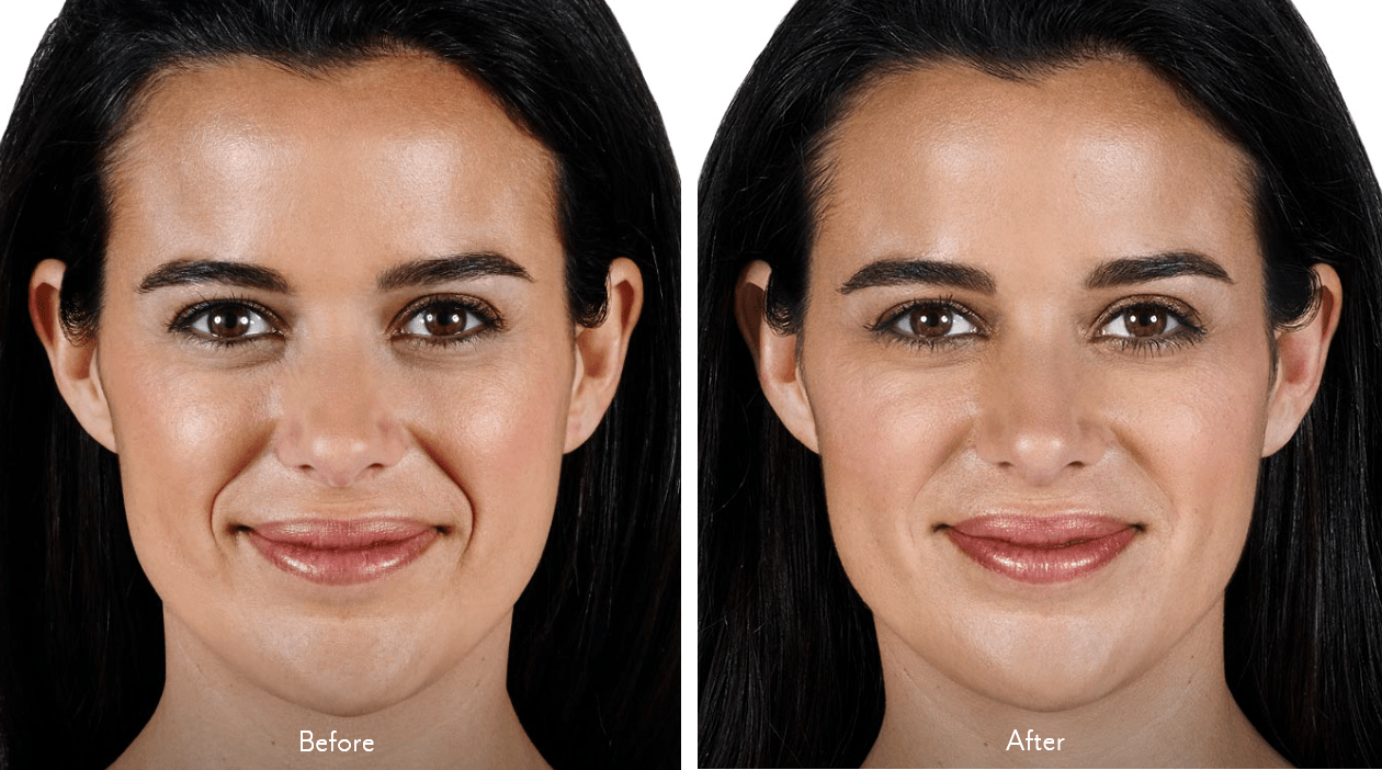 Juvederm-Vollure-Before-After-1