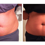 cavi-lipo-before-after-1-300x150