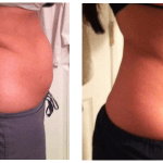 cavi-lipo-before-after-2-300x150