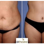 cavi-lipo-before-after-3-300x150