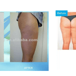 cavi-lipo-before-after-4-300x150