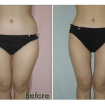 cavi-lipo-before-after-5-300x150