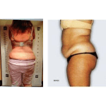 cavi-lipo-before-after-6-300x150