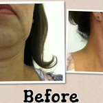 cavi-lipo-before-after-8-300x150