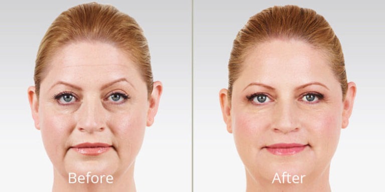juvederm-before-after-madison-connecticut-aria-dermspa-dermatology-aesthetic-center-full-2-768x383-1