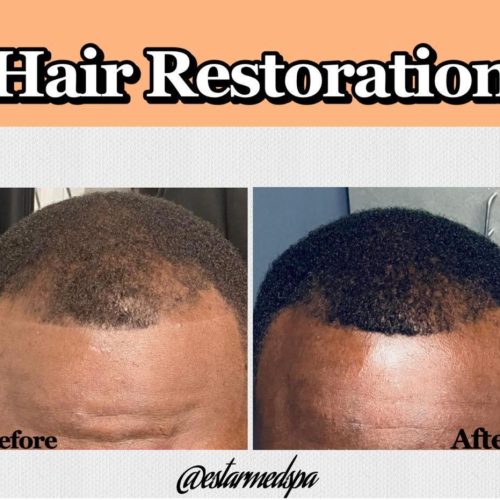 HairRestorationB4A1